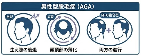 男性型脱毛症の進行イメージ